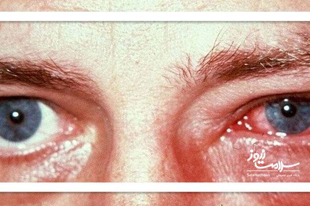 چرا موج انفجار به چشم آسیب می‌رساند؟