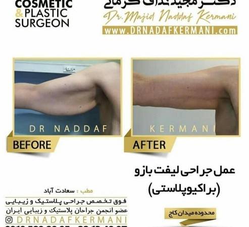 عمل لیفت بازو یا براکیوپلاستی چیست؟ + هزینه
