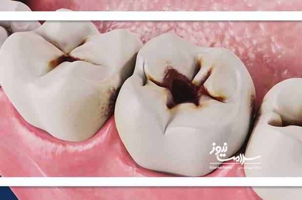 شایع‌ترین علت پوسیدگی دندان چیست؟