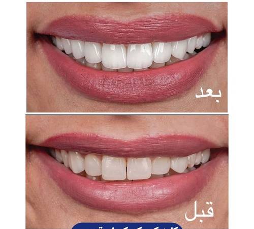 متخصص کامپوزیت دندان چه ویژگی‌هایی دارد؟