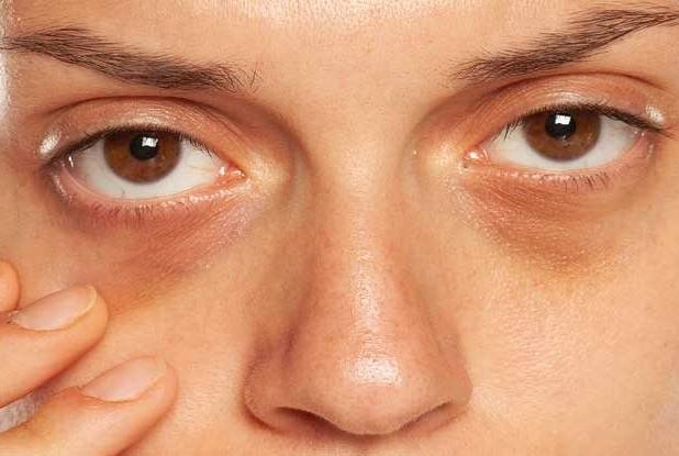 ترفندهای برطرف کردن ورم ، پف و کبودی چشم