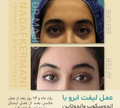لیفت ﺍبرو چیست و چگونه انجام می‌شود؟ + هزینه