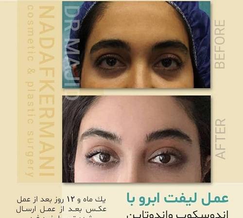 لیفت شقیقه چیست و چه روش‌هایی دارد؟