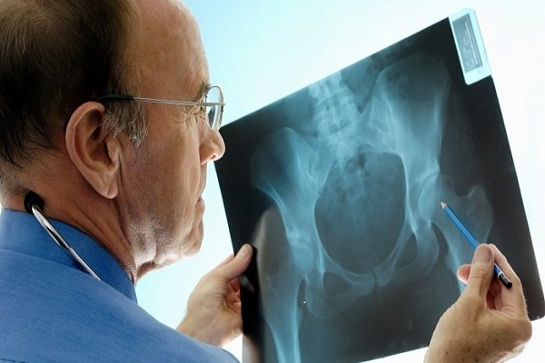 تشخیص و درمان آرتروز لگن با کمک هوش مصنوعی