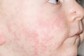 سرخک یا سرخچه چیست؟