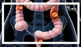 پیشگیری از سرطان روده بزرگ با راهکاری ساده