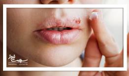 آیا آفت و تبخال با استرس تشدید می‌شوند؟/ درمان گیاهی چیست؟
