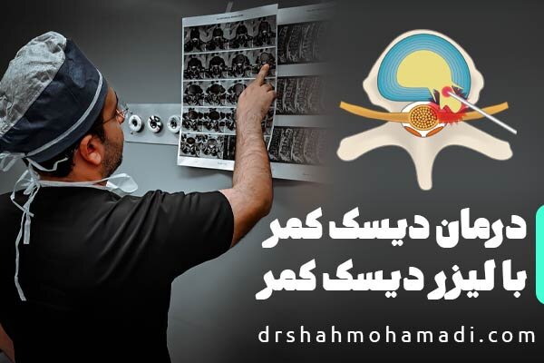 چگونگی درمان دیسک کمر با لیزر دیسک کمر PLDD و توصیه‌های جراح متخصص