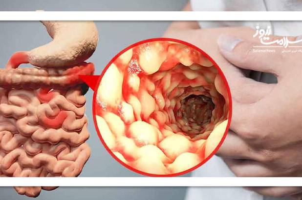 علائم بیماری کرون با این رژیم غذایی تسکین می‌یابد
