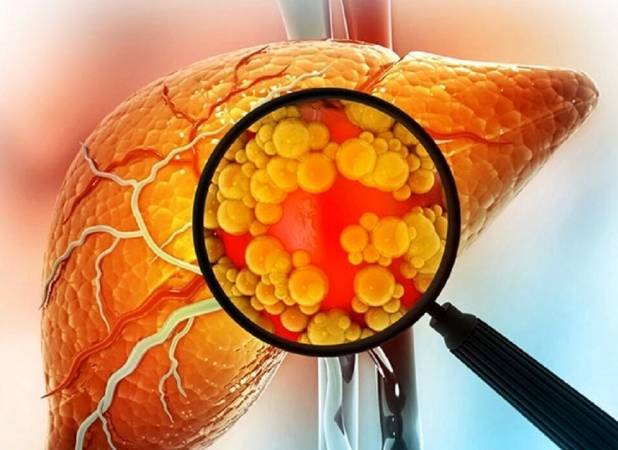 7 نشانه اصلی ابتلا به کبد چرب را بشناسید